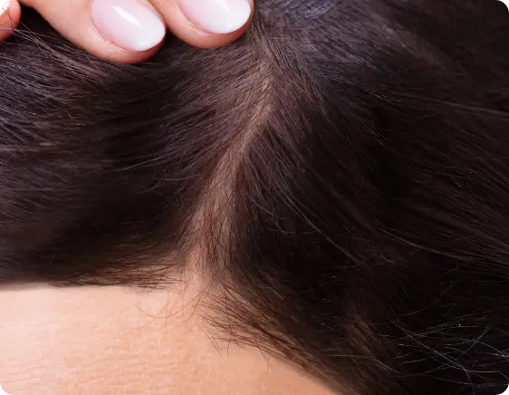 post-treatment hair regrowth with microneedling and PEP Factor