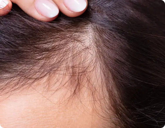 Thinning hair condition before microneedling treatment with PEP Factor