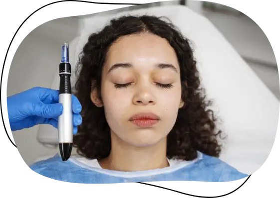 microneedling with pep factor procedure