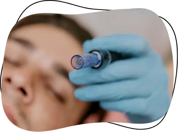 microneedling