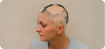 targeted microneedling treatment for patchy alopecia areata hair loss