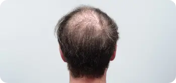 restorative microneedling treatment for telogen effluvium-related hair thinning