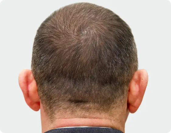 Thicker and healthier-looking hair after microneedling with PRP treatment