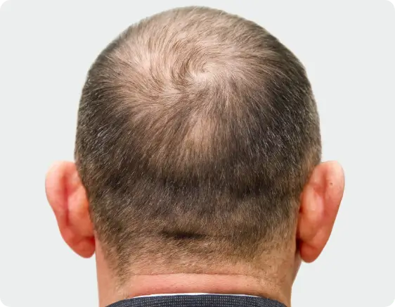 sparse hair condition before microneedling with PRP therap