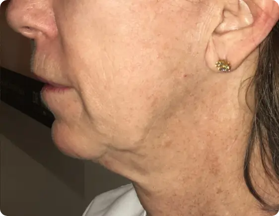 Aged and uneven skin appearance after Morpheus8 treatment