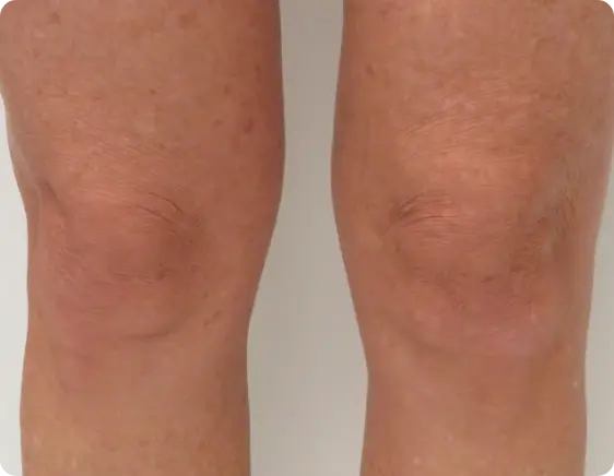 Aged and uneven skin appearance after Morpheus8 treatment