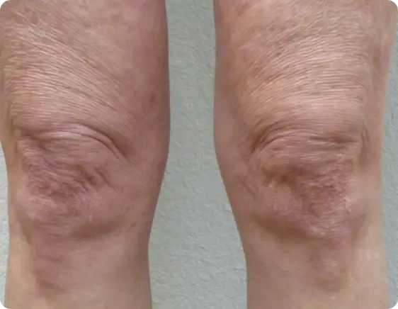 Aged and uneven skin appearance before Morpheus8 treatment