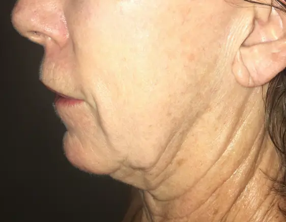 Aged and uneven skin appearance before Morpheus8 treatment