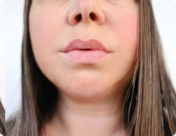facial changes and refined features after Ozempic use