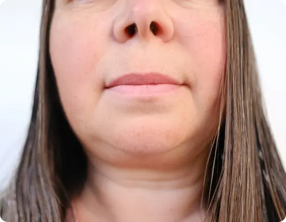 facial changes and refined features before Ozempic use