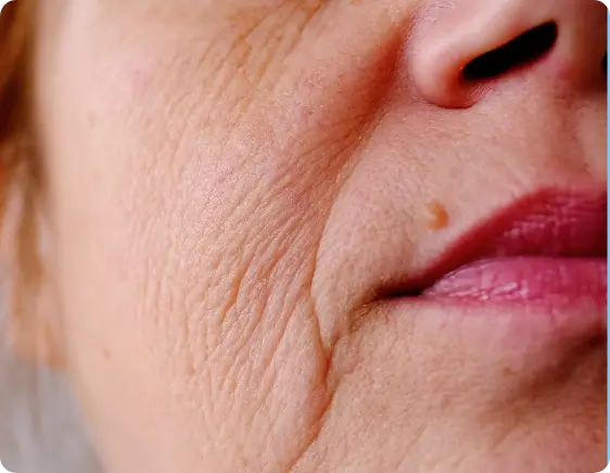 facial changes and refined features before Ozempic use