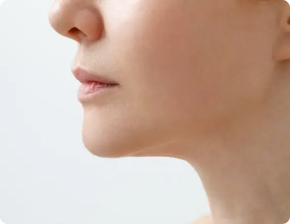 Lifted and rejuvenated facial appearance after PDO thread lift treatment