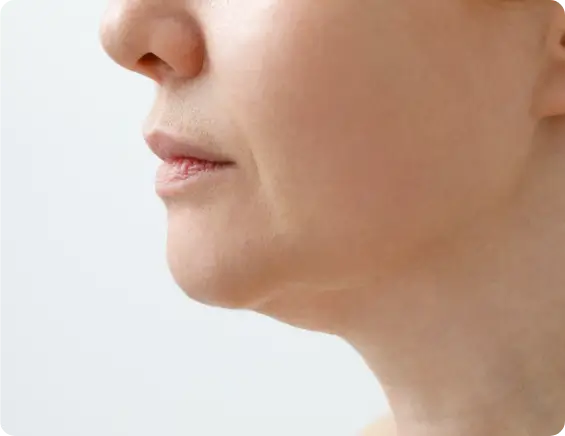 Lifted and rejuvenated facial appearance before PDO thread lift treatment