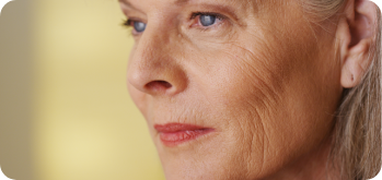 microneedling treatment for subtle and delicate facial fine lines