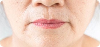 microneedling treatment for aging and sagging oral commissures