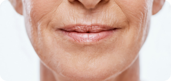 microneedling treatment for fine perioral lines around the mouth