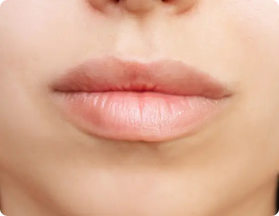 Smooth and natural-looking lips after Restylane Silk treatment