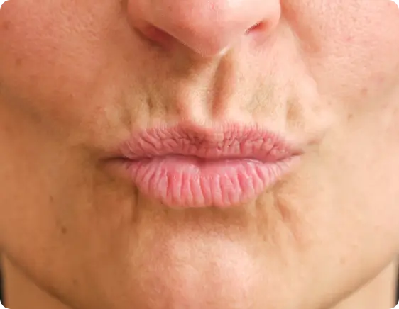 Smooth and natural-looking lips after Restylane Silk treatment