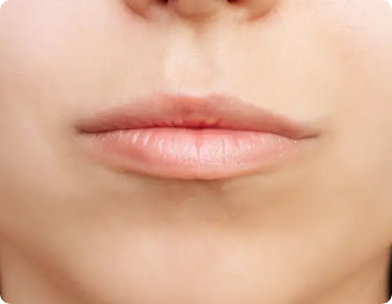 Natural lip appearance before subtle and smoothing Restylane Silk treatment