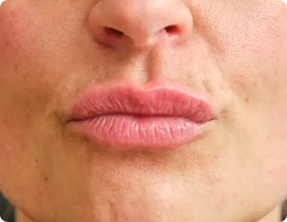 Natural lip appearance before subtle and smoothing Restylane Silk treatment